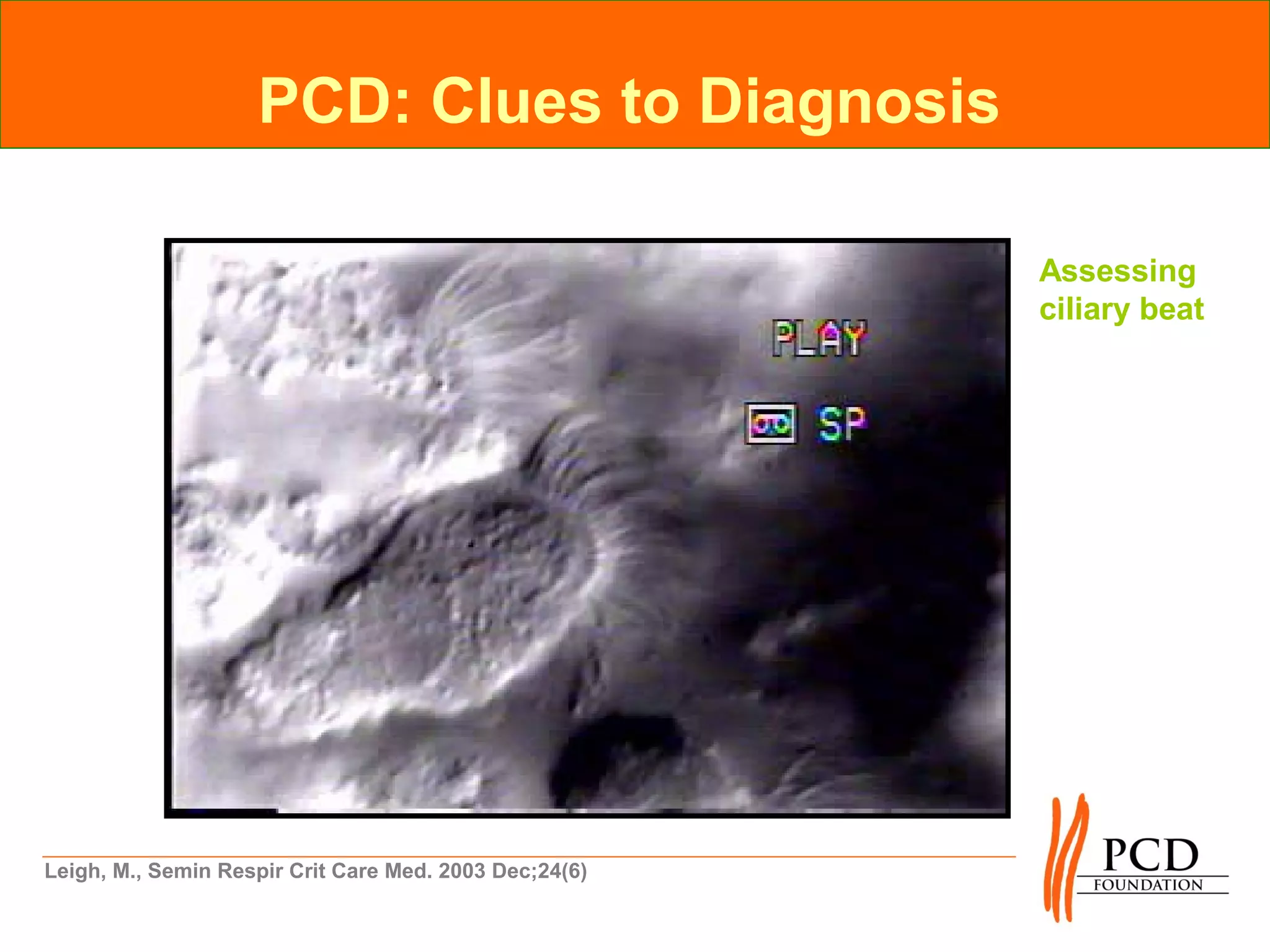 PCD: Clues to Diagnosis

                                                        Assessing
                                                        ciliary beat




Leigh, M., Semin Respir Crit Care Med. 2003 Dec;24(6)
 
