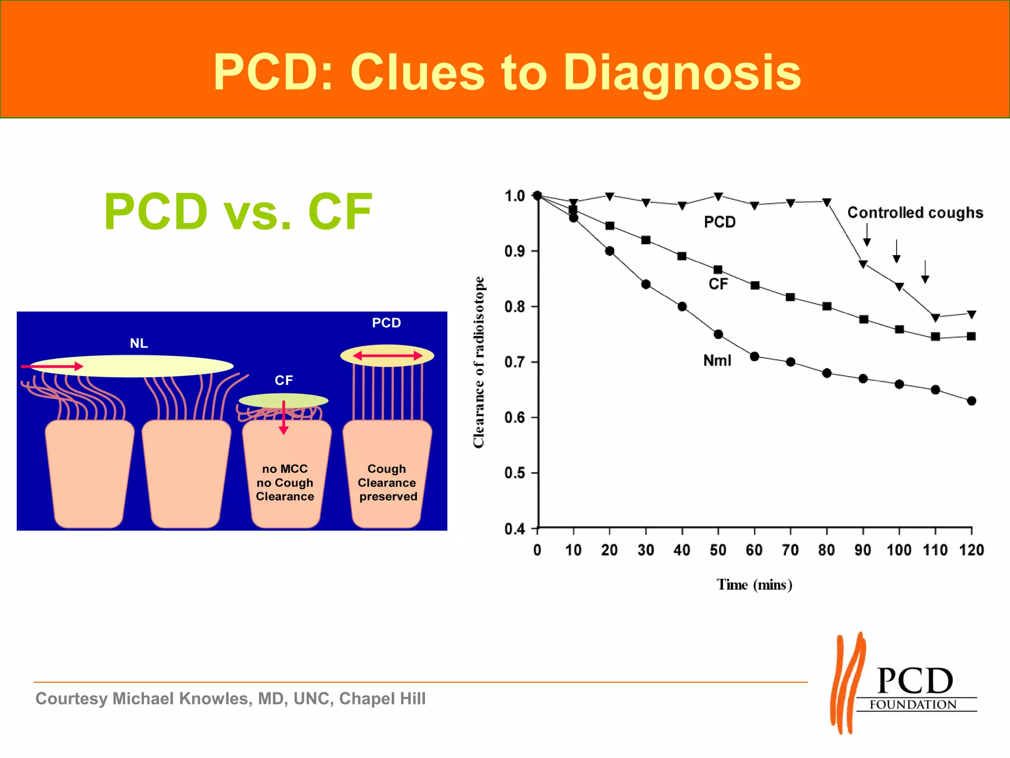 PCD: Clues to Diagnosis

       PCD vs. CF




Courtesy Michael Knowles, MD, UNC, Chapel Hill
 