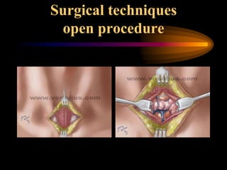 Surgical techniques
open procedure
 