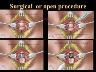 Surgical or open procedure
 