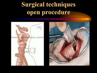 Surgical techniques
open procedure
 