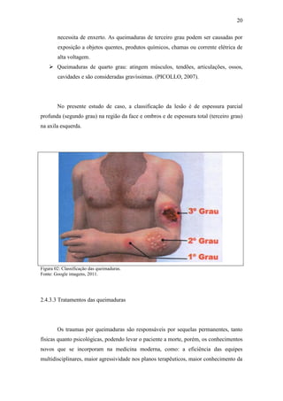 20

        necessita de enxerto. As queimaduras de terceiro grau podem ser causadas por
        exposição a objetos quentes, produtos químicos, chamas ou corrente elétrica de
        alta voltagem.
     Queimaduras de quarto grau: atingem músculos, tendões, articulações, ossos,
        cavidades e são consideradas gravíssimas. (PICOLLO, 2007).




        No presente estudo de caso, a classificação da lesão é de espessura parcial
profunda (segundo grau) na região da face e ombros e de espessura total (terceiro grau)
na axila esquerda.




Figura 02: Classificação das queimaduras.
Fonte: Google imagens, 2011.




2.4.3.3 Tratamentos das queimaduras




        Os traumas por queimaduras são responsáveis por sequelas permanentes, tanto
físicas quanto psicológicas, podendo levar o paciente a morte, porém, os conhecimentos
novos que se incorporam na medicina moderna, como: a eficiência das equipes
multidisciplinares, maior agressividade nos planos terapêuticos, maior conhecimento da
 