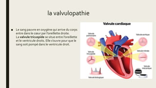 la valvulopathie
■ Le sang pauvre en oxygène qui arrive du corps
entre dans le cœur par l’oreillette droite.
La valvule tricuspide se situe entre l’oreillette
et le ventricule droits. Elle s’ouvre pour que le
sang soit pompé dans le ventricule droit.
 