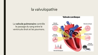 La valvule pulmonaire contrôle
le passage du sang entre le
ventricule droit et les poumons.
la valvulopathie
 