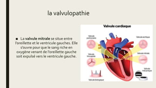 ■ La valvule mitrale se situe entre
l’oreillette et le ventricule gauches. Elle
s’ouvre pour que le sang riche en
oxygène venant de l’oreillette gauche
soit expulsé vers le ventricule gauche.
la valvulopathie
 