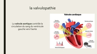 La valvule aortique contrôle la
circulation du sang du ventricule
gauche vers l’aorte
la valvulopathie
 