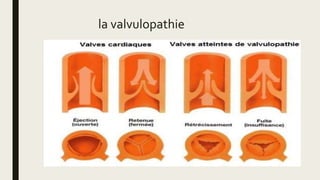 la valvulopathie
 