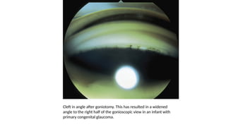 Cleft in angle after goniotomy. This has resulted in a widened
angle to the right half of the gonioscopic view in an infant with
primary congenital glaucoma.
 