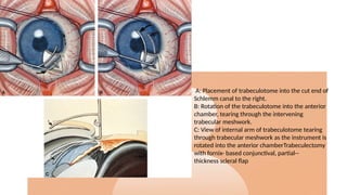 A: Placement of trabeculotome into the cut end of
Schlemm canal to the right.
B: Rotation of the trabeculotome into the anterior
chamber, tearing through the intervening
trabecular meshwork.
C: View of internal arm of trabeculotome tearing
through trabecular meshwork as the instrument is
rotated into the anterior chamberTrabeculectomy
with fornix- based conjunctival, partial--
thickness scleral flap
 