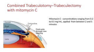 Combined Trabeculotomy–Trabeculectomy
with mitomycin C
Mitomycin C - concentrations ranging from 0.2
to 0.5 mg/mL, applied from between 2 and 5
minutes
 