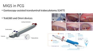 MIGS in PCG
• Gonioscopy-assisted transluminal trabeculotomy (GATT)
• Trab360 and Omni devices
 