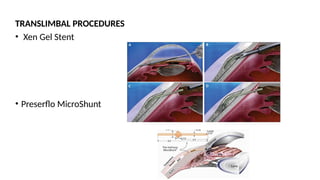 TRANSLIMBAL PROCEDURES
• Xen Gel Stent
• Preserflo MicroShunt
 