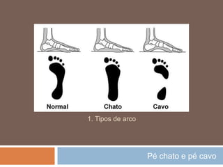 Pé chato e pé cavo
1. Tipos de arco
 