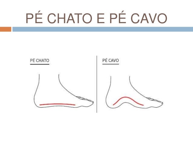 PÉ CHATO E PÉ CAVO
 