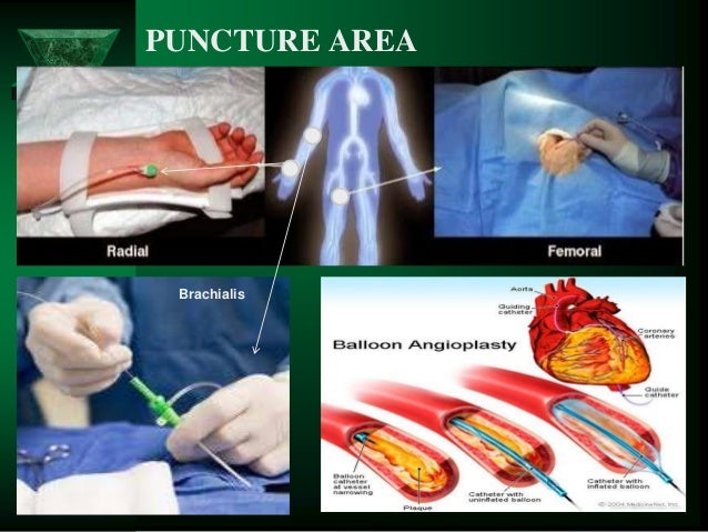 PCI (Percutaneous Coronary Intervention