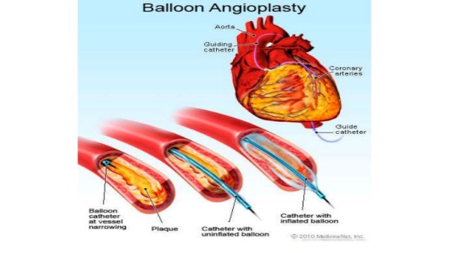 Percutaneous Coronary Intervention