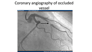 Coronary angiography of occluded
vessel
 