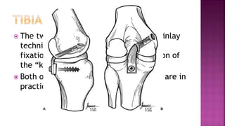 Pcl Inlay Posterior Cruciate Ligament Injury | PPT