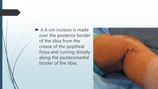  A 6-cm incision is made
over the posterior border
of the tibia from the
crease of the popliteal
fossa and curving distally
along the posteromedial
border of the tibia.
 