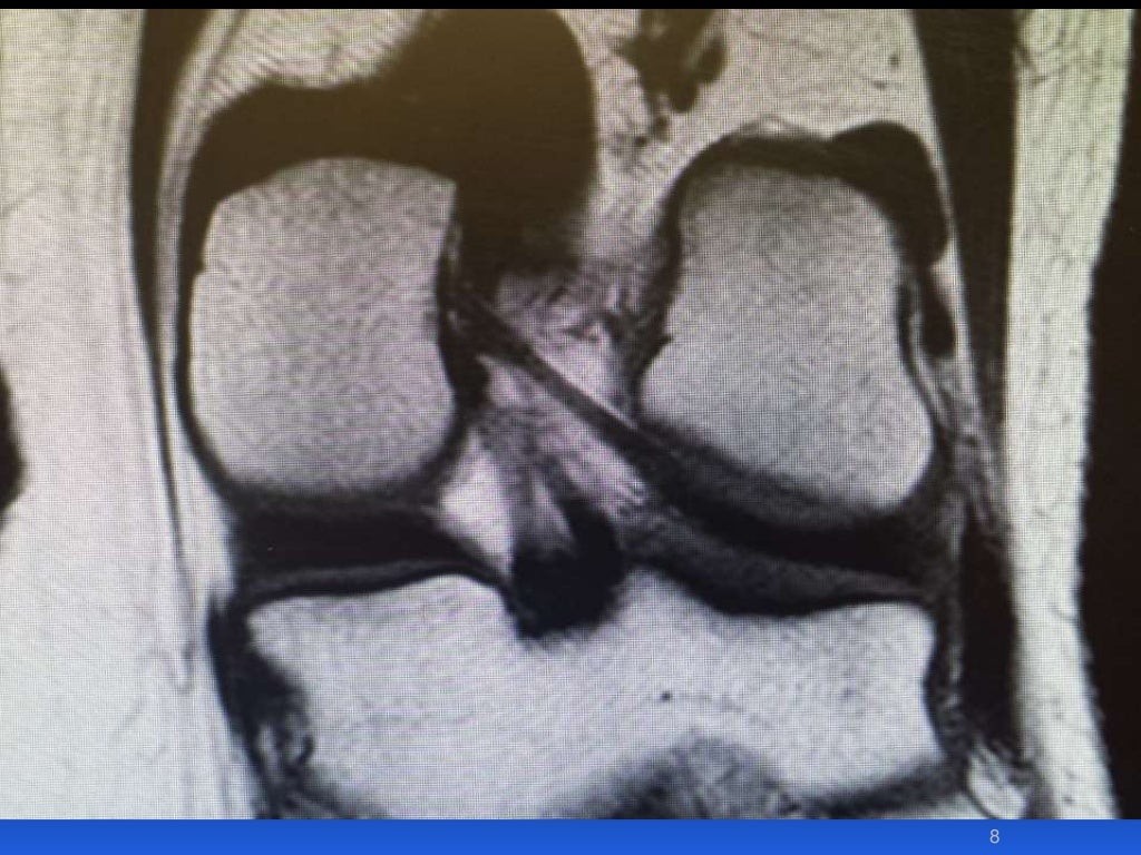 Knee Dislocation Pcl _ Multi-ligament injuries (Knee dislocation) – UODP