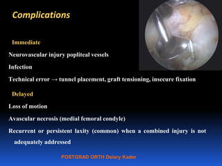 POSTGRAD ORTH Deiary Kader
Complications
Immediate
Neurovascular injury popliteal vessels
Infection
Technical error → tunnel placement, graft tensioning, insecure fixation
Delayed
Loss of motion
Avascular necrosis (medial femoral condyle)
Recurrent or persistent laxity (common) when a combined injury is not
adequately addressed
 