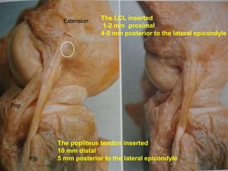 POSTGRAD ORTH Deiary Kader
28
Fib
Pop
Extension
The popliteus tendon inserted
10 mm distal
5 mm posterior to the lateral epicondyle
The LCL inserted
1-2 mm proximal
4-5 mm posterior to the lateral epicondyle
 