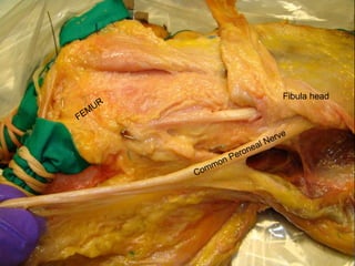 POSTGRAD ORTH Deiary Kader
29
Fibula head
 