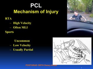 POSTGRAD ORTH Deiary Kader
PCL
Mechanism of Injury
RTA
– High Velocity
– Often MLI
Sports
Uncommon
– Low Velocity
– Usually Partial
7
 
