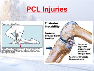 Comprehensive Overview and Rehabilitation of PCL Knee Injuries | PPT