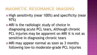 Pc Line Injury PCL TEAR.pptx posterior cruciate ligament injury | PPTX
