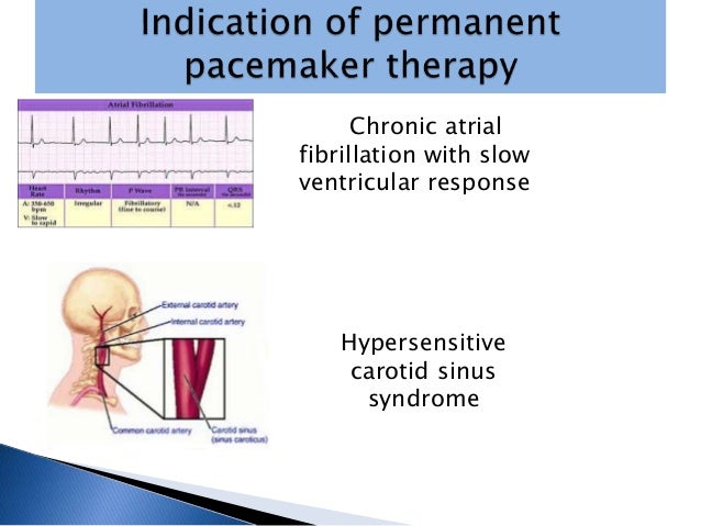 Single chamber pacemaker atrial fibrillation