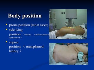 Body position prone position (most cases) side-lying position （ obesity 、 cardiorespiratory  dysfunction ） supine position （ transplanted kidney ） 