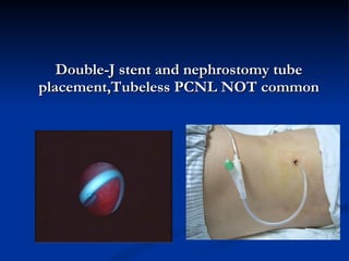 Double-J stent and nephrostomy tube placement,Tubeless PCNL NOT common 