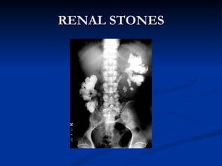 RENAL STONES 