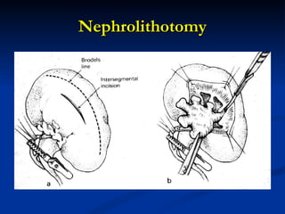 Nephrolithotomy 