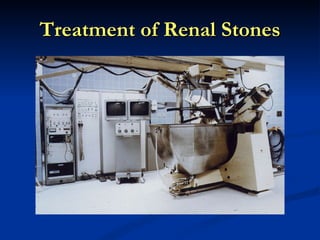 Treatment of Renal Stones 