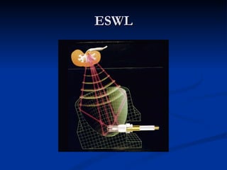 ESWL 
