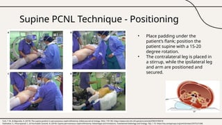 PCNL puncture Technique. Describe variation of puncture | PPTX