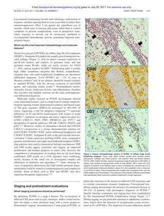 From bloodjournal.hematologylibrary.org by guest on July 25, 2011. For personal use only.
BLOOD, 21 JULY 2011 ⅐ VOLUME 118, NUMBER 3

HOW I TREAT PCNSL

513

I recommend maintaining steroids until radiologic conﬁrmation of
response, and then tapering them as soon as possible to reduce their
immunosuppressive effect. I am against any superﬂuous use of
steroids, which aims to reassure physicians rather than to control
symptoms or prevent complications, even in prospective trials,
where response to steroids can be erroneously attributed to
investigational chemotherapy activity, generating important interpretation biases.
Which are the most important histopathologic and molecular
features?

Ninety-ﬁve percent of PCNSLs are diffuse large B-cell lymphomas
(DLBCL). Neoplastic B lymphocytes usually grow forming perivascular cufﬁngs (Figure 3), with an almost constant expression of
pan-B-cell markers and markers of germinal center and late
germinal center B cells, while are rarely positive for CD10
(Ͻ 10%), and are negative for EBV.11 Proliferating index is usually
high. Other lymphoma categories like Burkitt, lymphoblastic,
marginal zone, and small lymphocytic lymphoma are uncommon
differential diagnoses. T-cell PCNSLs are ϳ 2% of cases in
Western countries3 and, in my opinion, should be treated similarly
to standard PCNSL, with the obvious exclusion of anti-CD20
agents, and expecting similar results.12 Neuroepithelial tumors,
metastatic lesions, histiocytic lesions, and inﬂammatory disorders
like vasculitis and multiple sclerosis are the main nonlymphomatous differential diagnoses.
Molecular studies focused on PCNSL development showed
some interesting features, such as a high load of somatic mutations,
frequent ongoing somatic hypermutation patterns and biased usage
of VH gene segments (IGHV4-34 rearranged in 50%-80% of
cases), suggesting a role for antigen(s) triggering13,14; important
differences in IG and BCL6 translocations with respect to nodal
DLBCL15; mutations in oncogene and tumor suppressor gene loci
(CD95, CMYC13, PAX5, PIM1, PRDM114, and TTF)15; and
deregulation of speciﬁc pathways (NF-␬B, CARD11, MALT1, and
p50).16,17 Moreover, studies of chemokines showed that CXCL9/
CXCL12 coexpression is a strong chemoattractant stimulus for
both CXCR4ϩ/CXCR3ϩ/CD8ϩ tumor-inﬁltrating lymphocytes and
CXCR4ϩ/CXCR3Ϫ malignant B cells in the perivascular microenvironment.18 Gene expression proﬁling (GEP), array comparative
genomic hybridization, and single-nucleotide polymorphism (SNP)–
chip analyses were used to characterize biologic mechanisms. SNP
and GEP results appear consistent and suggest an improved
proliferation and harmed apoptosis in tumor cells; however, the
comprehensive interpretation of resulting data are far from being
established. GEP results on a CNS signature were conﬂicting,
mostly because of the small size of investigated samples and
differences in platforms and algorithms.19-21 Gene silencing because of epigenetic phenomena like CpG islands promoter hypermethylation could be related to lymphomagenesis and lymphocyte
motility. Some of them, such as RFC and MGMT, may have
important therapeutic implications.22,23

Staging and pretreatment evaluations
Which staging procedures should be performed?

By deﬁnition, PCNSL is a stage I disease. The involvement of
different CNS areas such as eyes, meninges, and/or cranial nerves,
does not imply a more advanced stage with a worse prognosis.
Pretreatment “staging” procedures have 2 main goals in PCNSL: to

Figure 3. Classic histopathologic picture of PCNSL of diffuse large B-cell
lymphoma category. Tumor cells (ﬁlled arrows) usually grow forming classic
perivascular cufﬁngs, are CD20 positive, and express other pan-B-cell markers
(CD19, CD20, CD22, CD79a), markers of germinal center B cells (bcl-6; 60%-80% of
cases), and markers of late germinal center B cells (MUM1; 90%), while are CD3
negative. A reactive T-cell inﬁltrate (open arrows) constituted by a perivascular rim of
small lymphocytes interposed between vessel (VL) and neoplastic cells is observed
in one-third of cases. These lymphocytes are smaller than neoplastic ones, and are
CD20 negative and CD3 positive. The presence of this reactive inﬁltrate is associated
with signiﬁcantly better outcome in patients treated with modern approach.

deﬁne the extension of the disease in different CNS structures and
to exclude concomitant systemic lymphoma. Conventional lymphoma staging demonstrates the presence of extraneural disease in
4%-12% of patients with presumptive diagnosis of PCNSL.24
Speciﬁc baseline evaluations and staging have been standardized
by The International PCNSL Collaborative Group (Figure 1).10
During staging, we pay particular attention to ophthalmic examinations, which allow the detection of asymptomatic ocular involvement in 5% of PCNSLs. The suspicion of ocular inﬁltration should

 