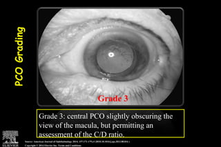 Pco - by dr. Heba mahmoud (M D)