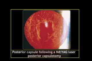 Pco - by dr. Heba mahmoud (M D)