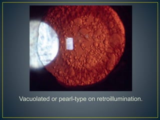 Vacuolated or pearl-type on retroillumination.
 