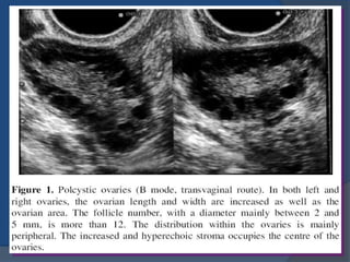 Pcod Radiographically Pcod | PPTX