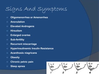 Signs And Symptoms 
 Oligomenorrhea or Amenorrhea 
 Anovulation 
 Elevated Androgens 
 Hirsutism 
 Enlarged ovaries 
...