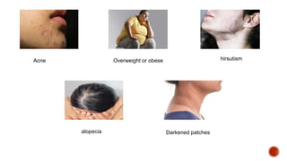 hirsutism
Overweight or obese
Acne
alopecia Darkened patches
 