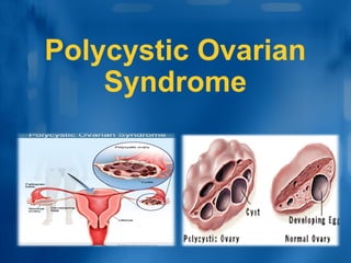 Polycystic Ovarian
Syndrome
 