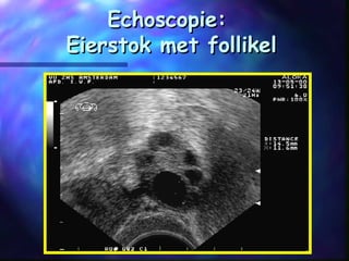 Echoscopie:Echoscopie:
Eierstok met follikelEierstok met follikel
 