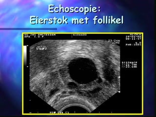 Echoscopie:Echoscopie:
Eierstok met follikelEierstok met follikel
 