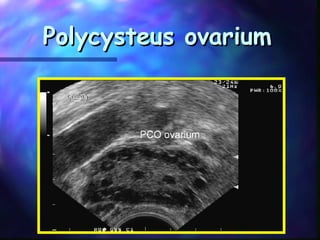Polycysteus ovariumPolycysteus ovarium
 