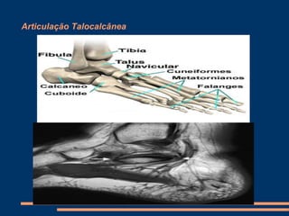 Articulação Talocalcânea
 